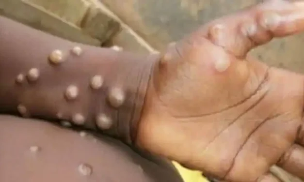 Monkeypox : പ്രതിരോധിക്കാൻ സത്വര നടപടി വേണമെന്ന് WHO, രോഗബാധയുണ്ടായാൽ നേരിടാൻ സജ്ജമെന്ന് ICMR